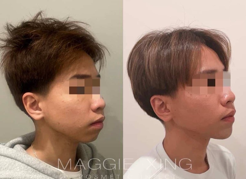 Male Lower Face Enhancement