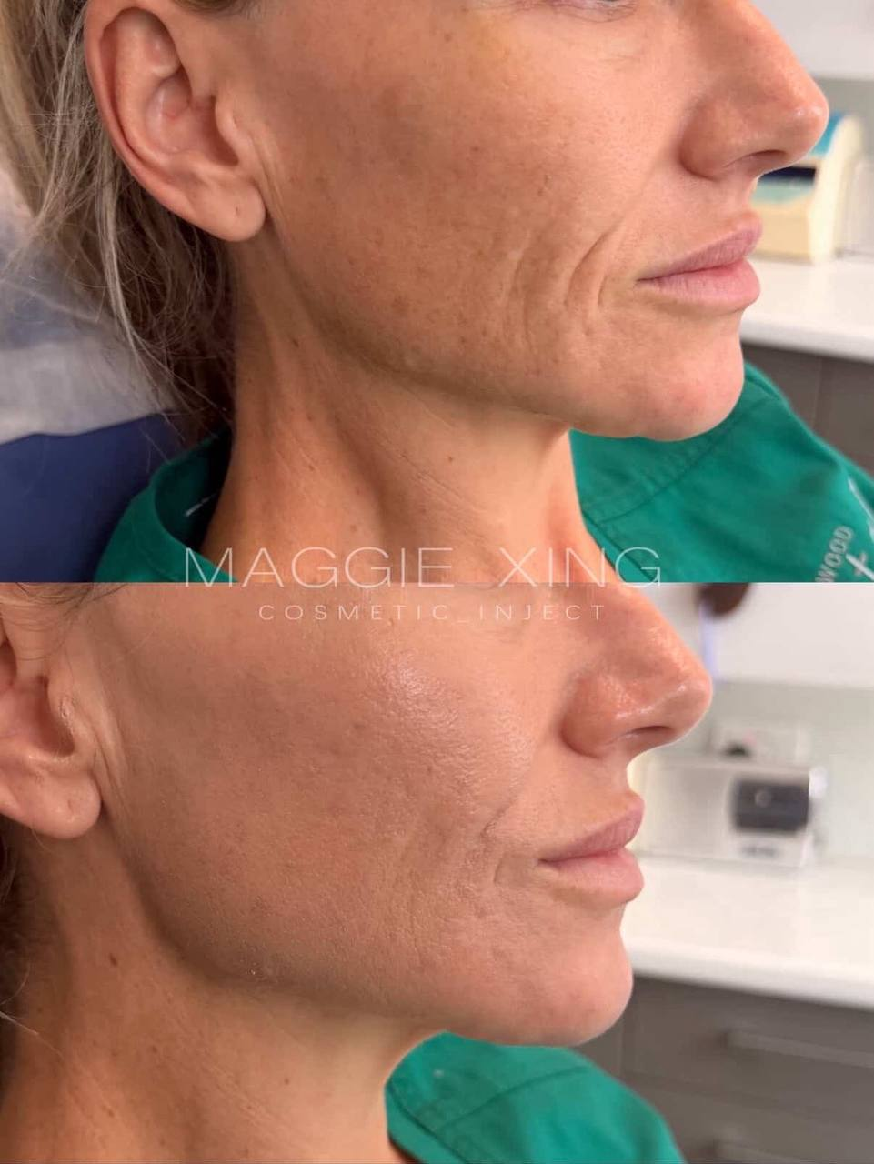 Smile Line Treatment