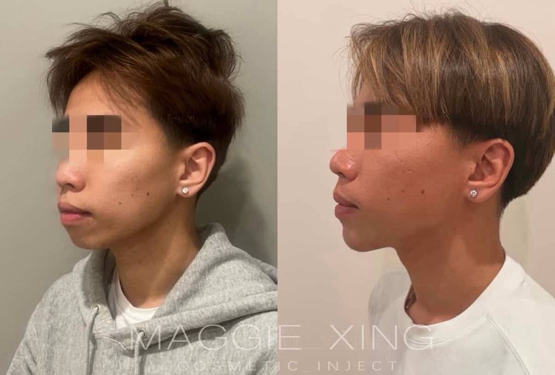 Male Lower Face Enhancement