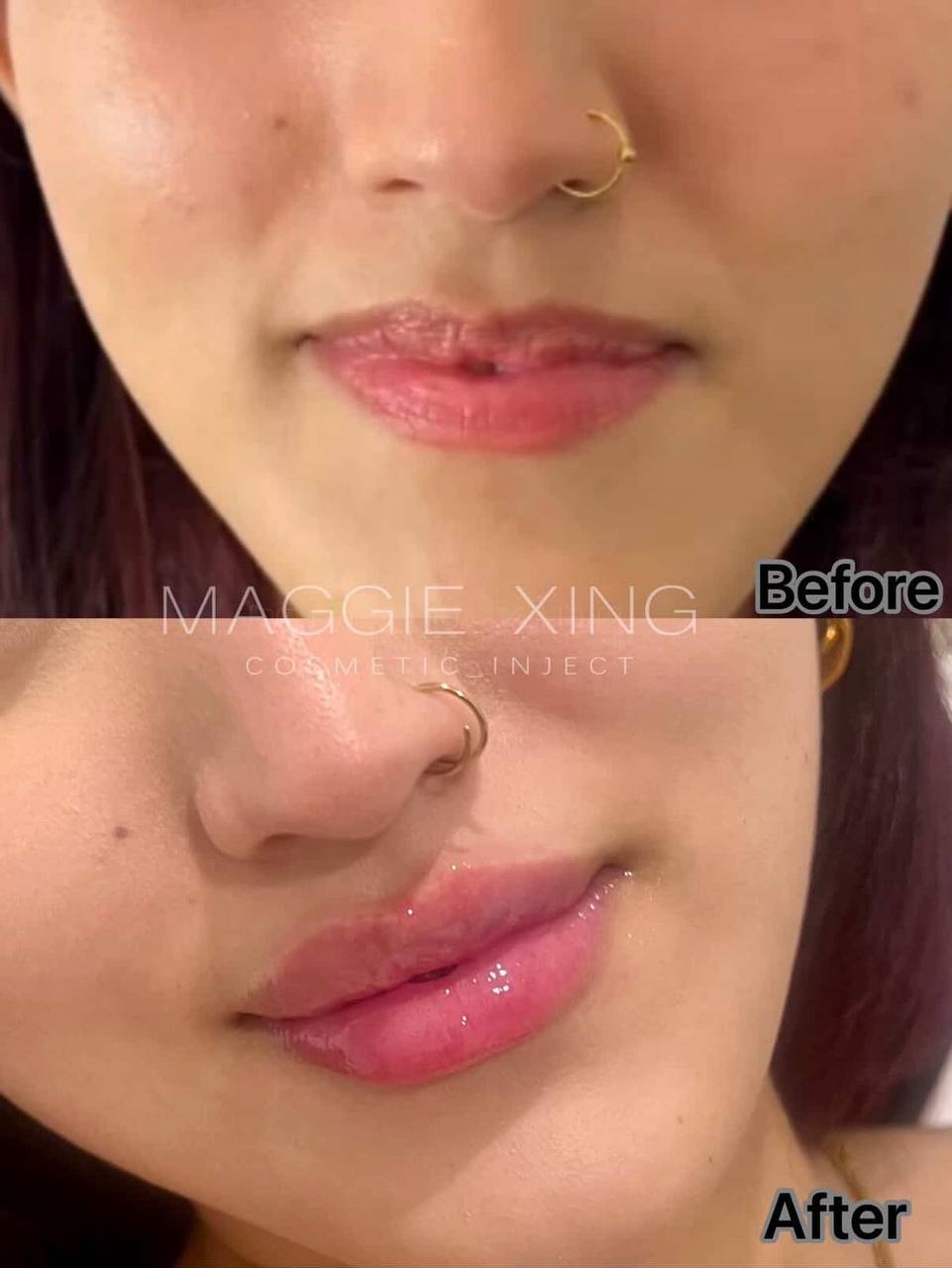 Lip Enhancement